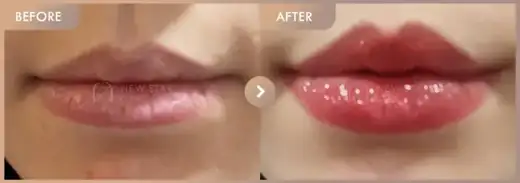 Lip filler: before-and-after comparison at Newstar Clinic