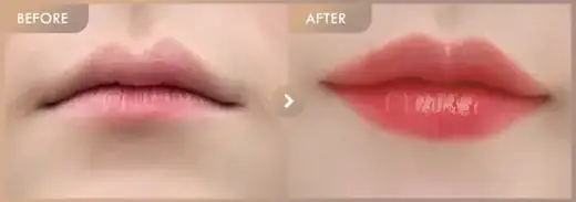 Lip filler: before-and-after comparison at Newstar Clinic