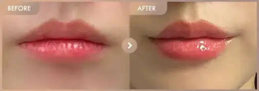 Lip filler: before-and-after comparison at Newstar Clinic