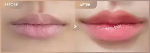 Lip filler: before-and-after comparison at Newstar Clinic