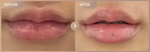 Lip filler: before-and-after comparison at Newstar Clinic