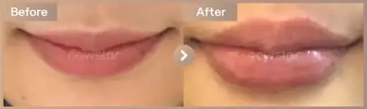 Lip filler: before-and-after comparison at Newstar Clinic