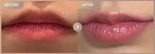 Lip filler: before-and-after comparison at Newstar Clinic