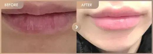 Lip filler: before-and-after comparison at Newstar Clinic