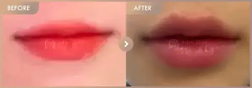 Lip filler: before-and-after comparison at Newstar Clinic