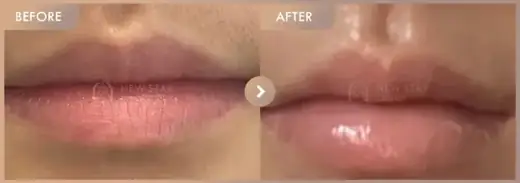 Lip filler: before-and-after comparison at Newstar Clinic