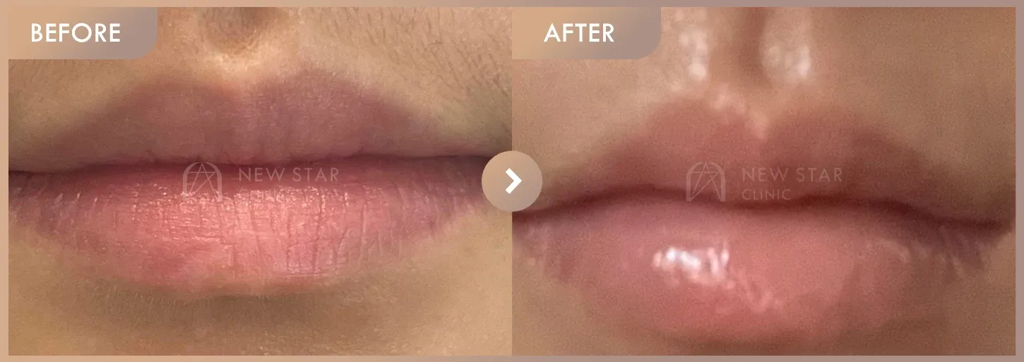 Lip filler before-and-after photos at Newstar Clinic