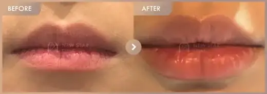 Lip filler: before-and-after comparison at Newstar Clinic