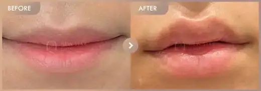 Lip filler: before-and-after comparison at Newstar Clinic