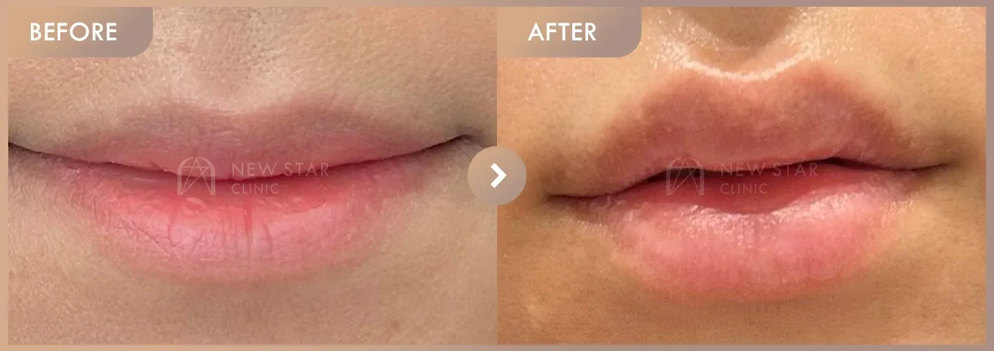 Lip filler before-and-after photos at Newstar Clinic