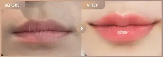 Lip filler: before-and-after comparison at Newstar Clinic