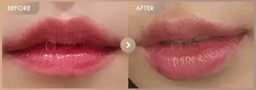 Lip filler: before-and-after comparison at Newstar Clinic