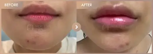 Lip filler + Chin filler: before-and-after comparison at Newstar Clinic