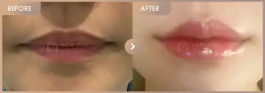 Lip filler: before-and-after comparison at Newstar Clinic