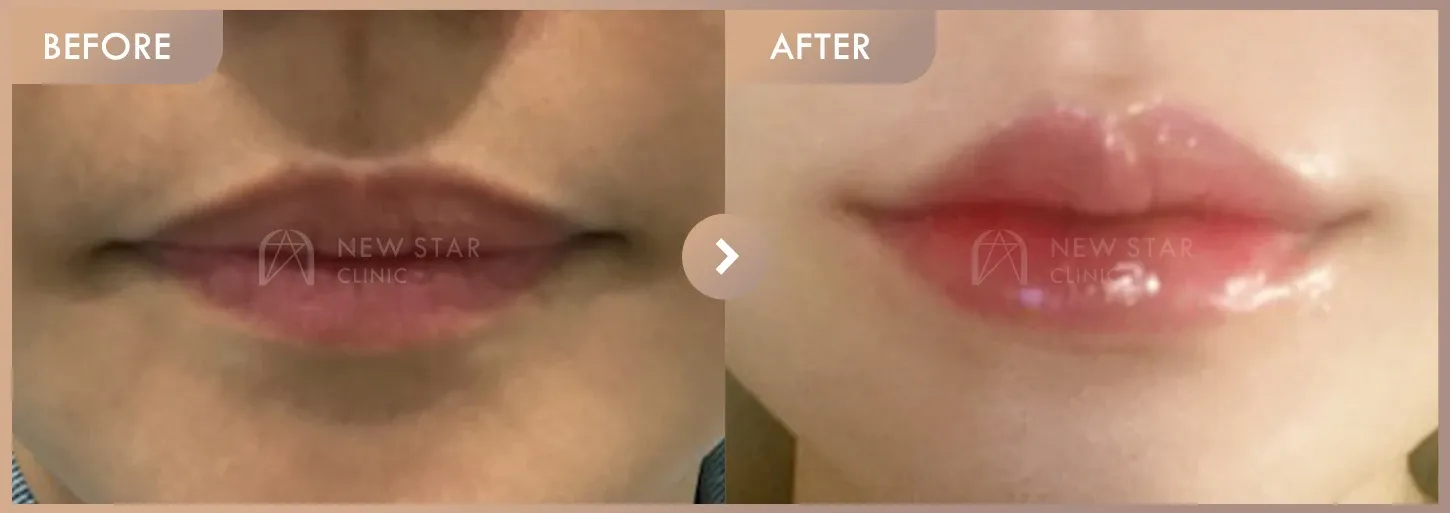 Lip filler before-and-after photos at Newstar Clinic