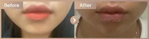 Lip filler: before-and-after comparison at Newstar Clinic