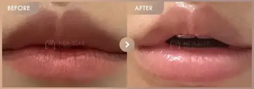 Lip filler: before-and-after comparison at Newstar Clinic