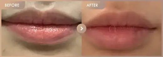 Lip filler: before-and-after comparison at Newstar Clinic