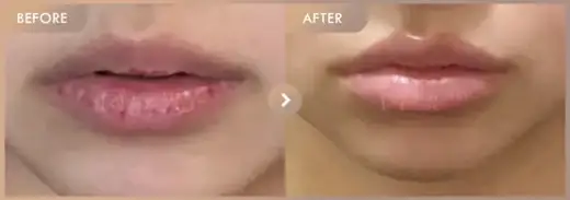 Lip filler: before-and-after comparison at Newstar Clinic