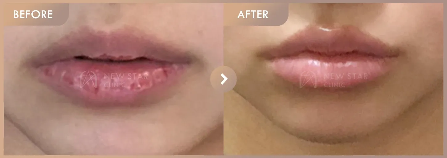 Lip filler before-and-after photos at Newstar Clinic