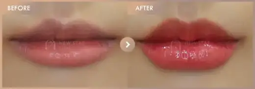 Lip filler: before-and-after comparison at Newstar Clinic