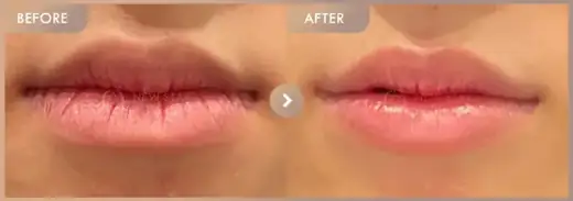 Lip filler: before-and-after comparison at Newstar Clinic