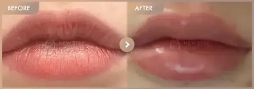 Lip filler: before-and-after comparison at Newstar Clinic