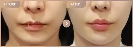 Lip filler + Chin filler: before-and-after comparison at Newstar Clinic