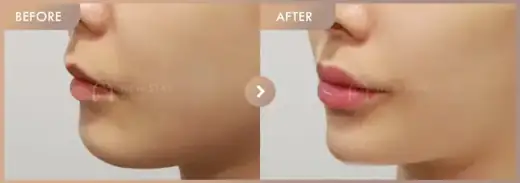 Lip filler + Chin filler · 01: before-and-after comparison at Newstar Clinic