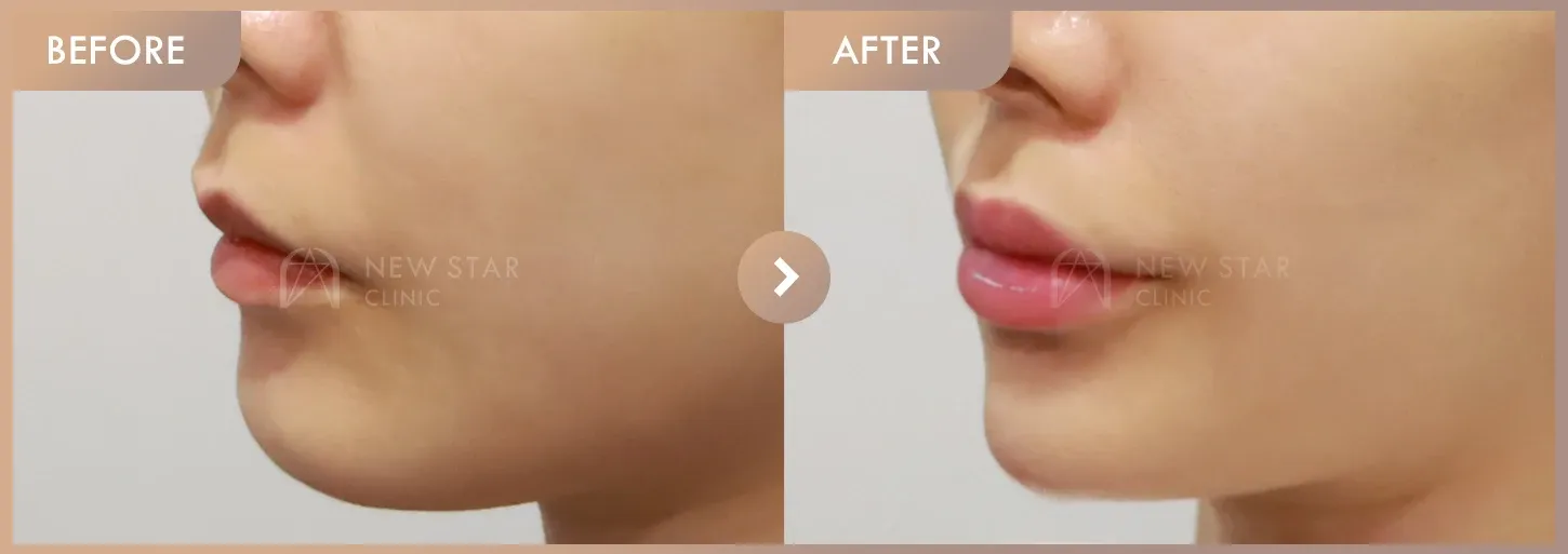 Lip filler + Chin filler · 01 before-and-after photos at Newstar Clinic