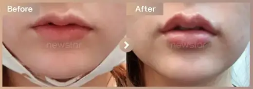 Lip filler: before-and-after comparison at Newstar Clinic
