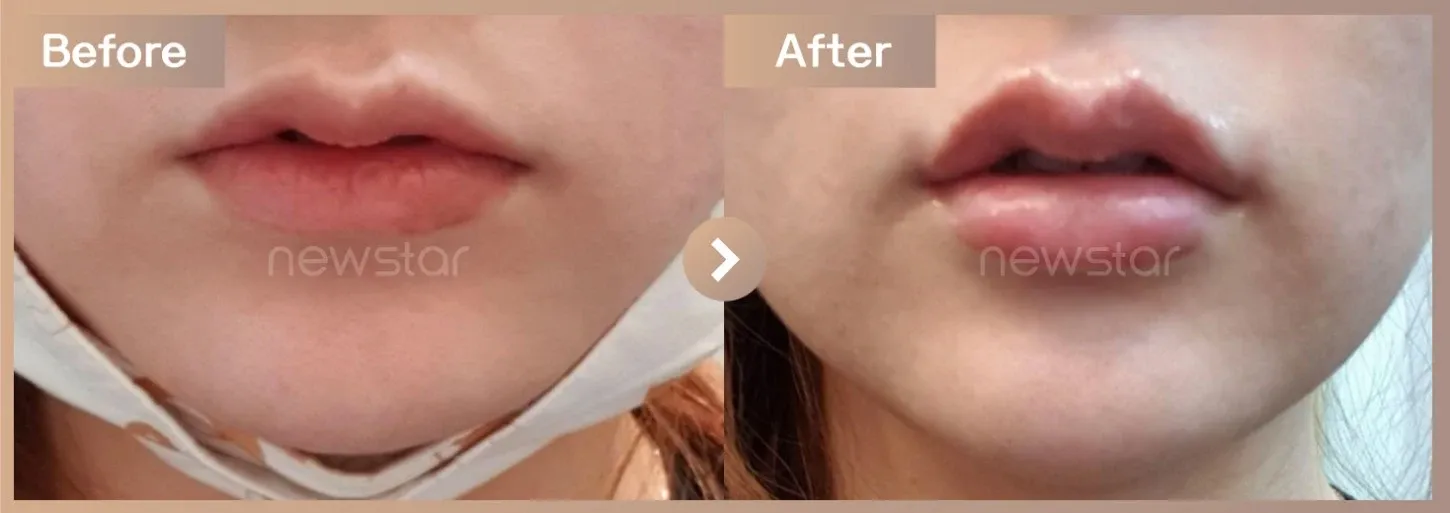 Lip filler before-and-after photos at Newstar Clinic