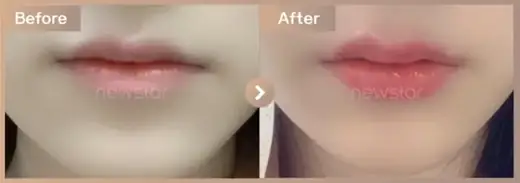 Lip filler: before-and-after comparison at Newstar Clinic