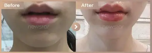 Lip filler: before-and-after comparison at Newstar Clinic