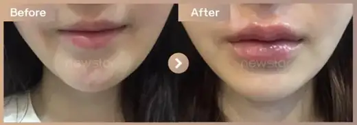 Lip filler: before-and-after comparison at Newstar Clinic