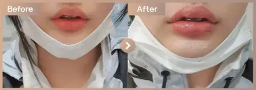 Lip filler: before-and-after comparison at Newstar Clinic