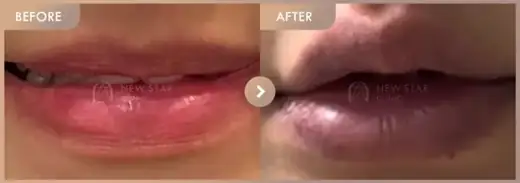 Lip fillers: before-and-after comparison at Newstar Clinic