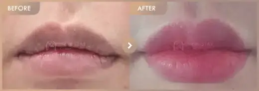 Lip fillers: before-and-after comparison at Newstar Clinic