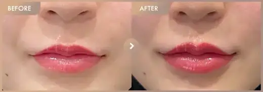 Lip fillers: before-and-after comparison at Newstar Clinic