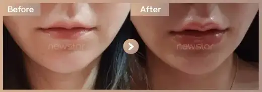 Lip filler: before-and-after comparison at Newstar Clinic