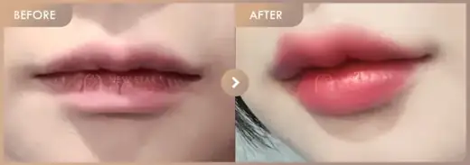 Lip filler: before-and-after comparison at Newstar Clinic