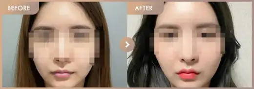 Lip filler + Forehead filler: before-and-after comparison at Newstar Clinic
