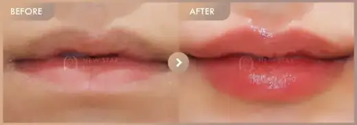 Lip filler: before-and-after comparison at Newstar Clinic