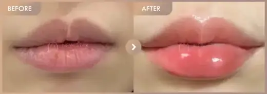 Lip filler: before-and-after comparison at Newstar Clinic