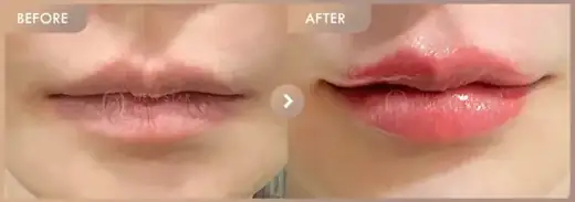 Lip filler: before-and-after comparison at Newstar Clinic