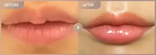 Lip filler: before-and-after comparison at Newstar Clinic