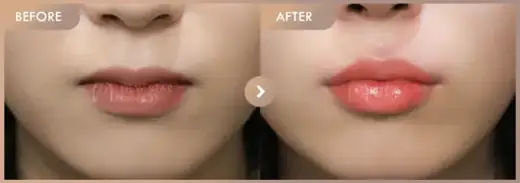 Lip filler: before-and-after comparison at Newstar Clinic