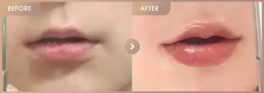 Lip filler: before-and-after comparison at Newstar Clinic