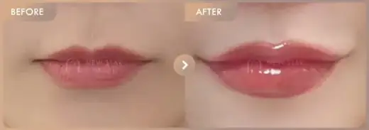 Lip filler: before-and-after comparison at Newstar Clinic