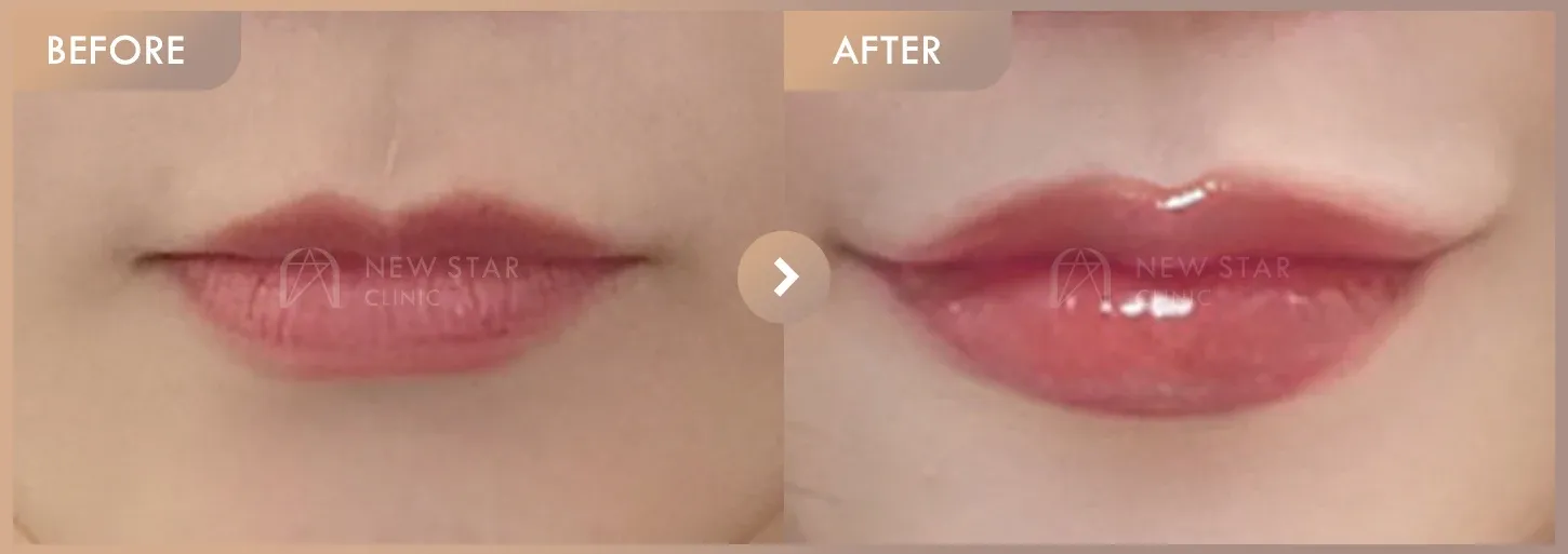Lip filler before-and-after photos at Newstar Clinic